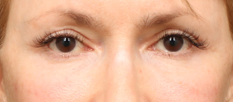 Brow / Temple Lift Before & After Image