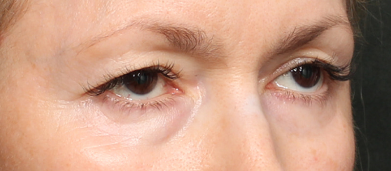 Brow / Temple Lift Before & After Image