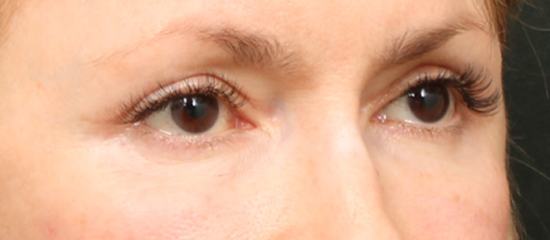 Brow / Temple Lift Before & After Image