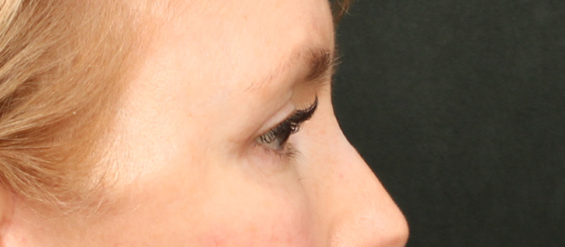 Brow / Temple Lift Before & After Image