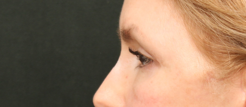 Brow / Temple Lift Before & After Image