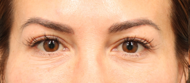 Brow / Temple Lift Before & After Image