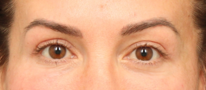 Brow / Temple Lift Before & After Image