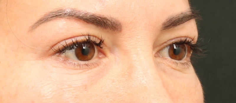 Brow / Temple Lift Before & After Image