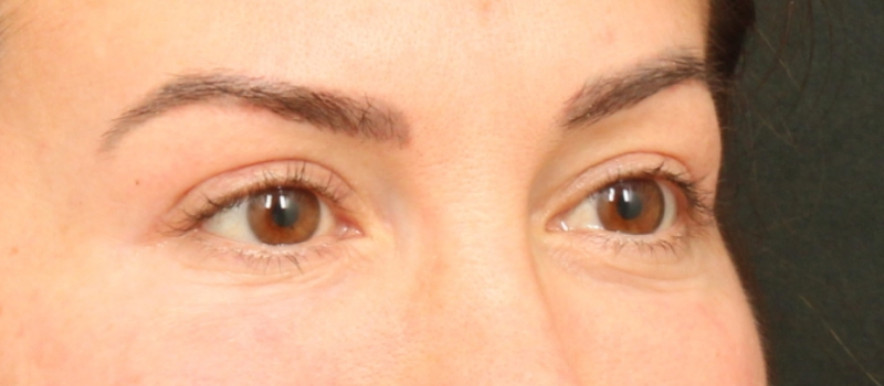 Brow / Temple Lift Before & After Image