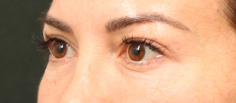 Brow / Temple Lift Before & After Image