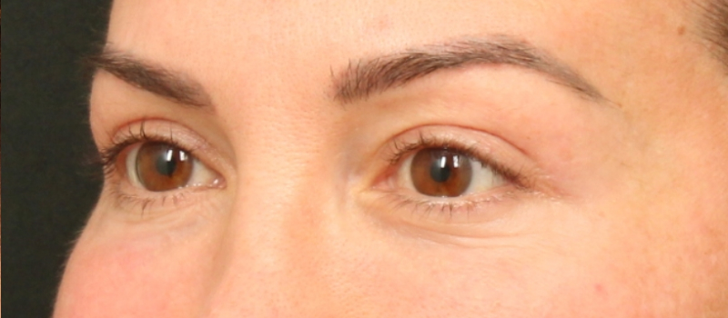 Brow / Temple Lift Before & After Image