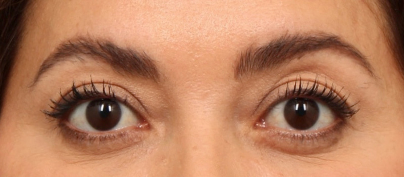 Brow / Temple Lift Before & After Image