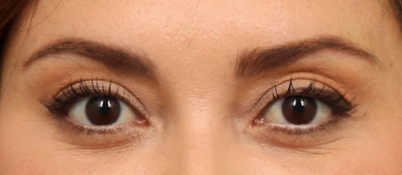 Brow / Temple Lift Before & After Image