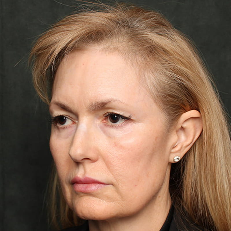 Lower Blepharoplasty Before & After Image