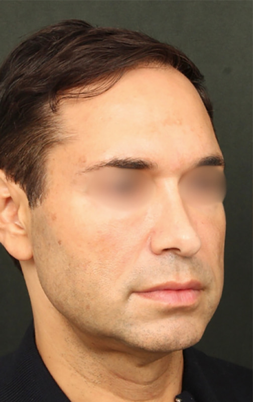 Deep Plane Facelift Before & After Image