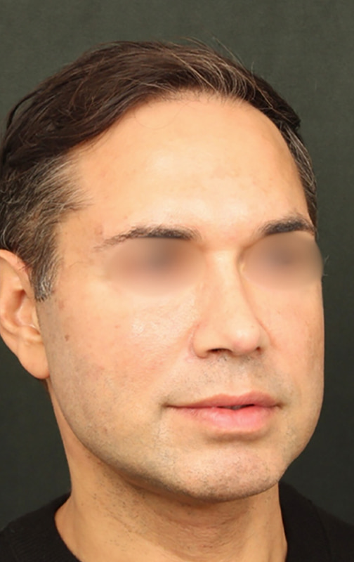 Deep Plane Facelift Before & After Image