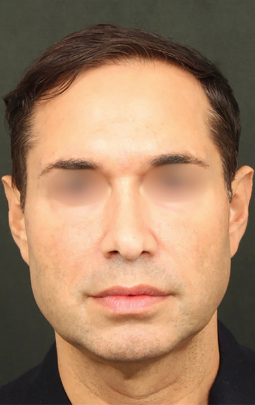 Deep Plane Facelift Before & After Image