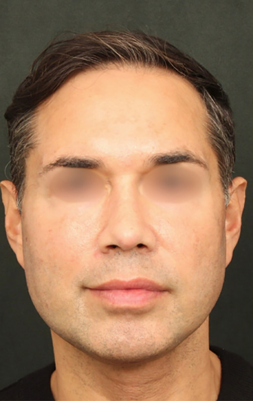 Deep Plane Facelift Before & After Image