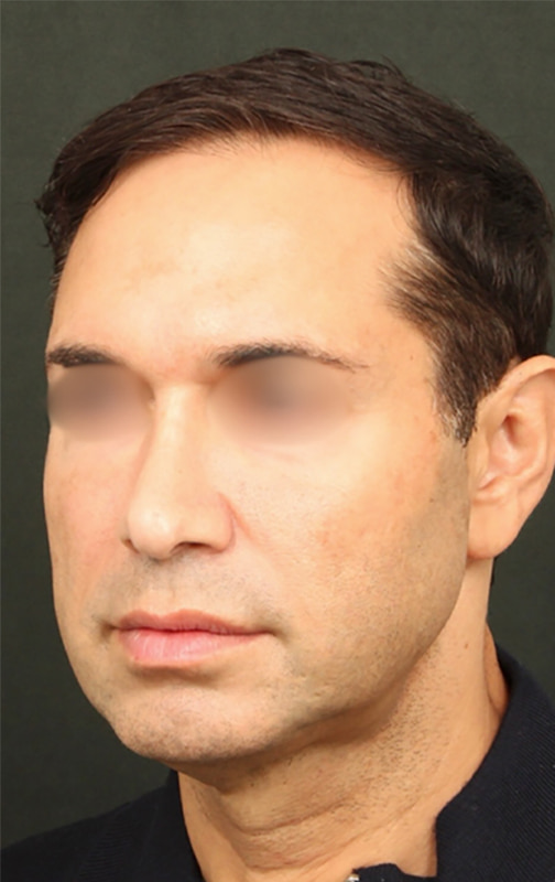 Deep Plane Facelift Before & After Image