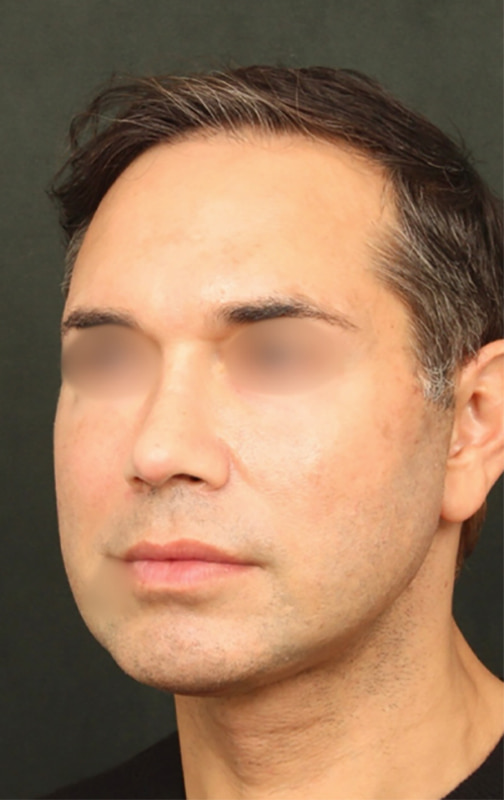 Deep Plane Facelift Before & After Image