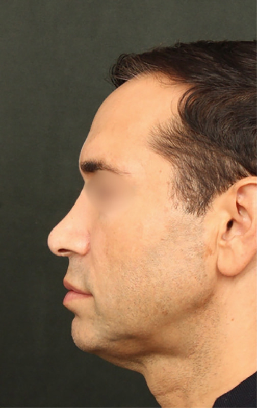 Deep Plane Facelift Before & After Image