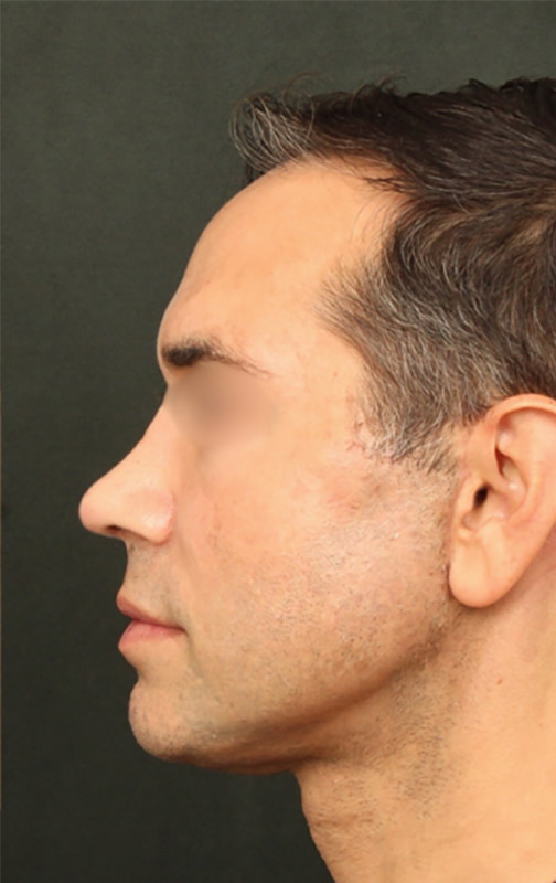 Deep Plane Facelift Before & After Image