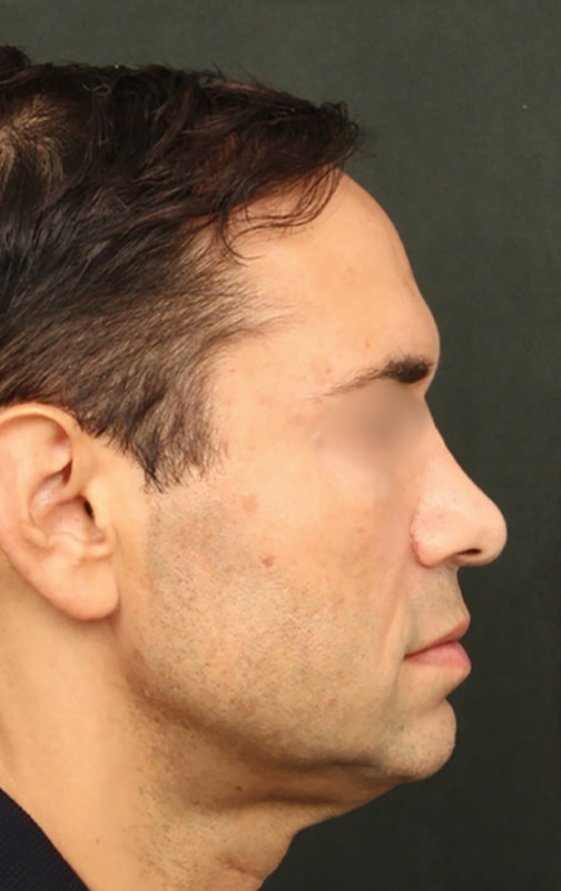 Deep Plane Facelift Before & After Image