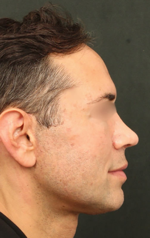 Deep Plane Facelift Before & After Image