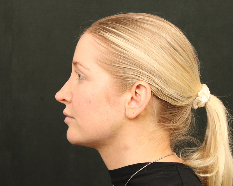 Midline Neck Lift Before & After Image