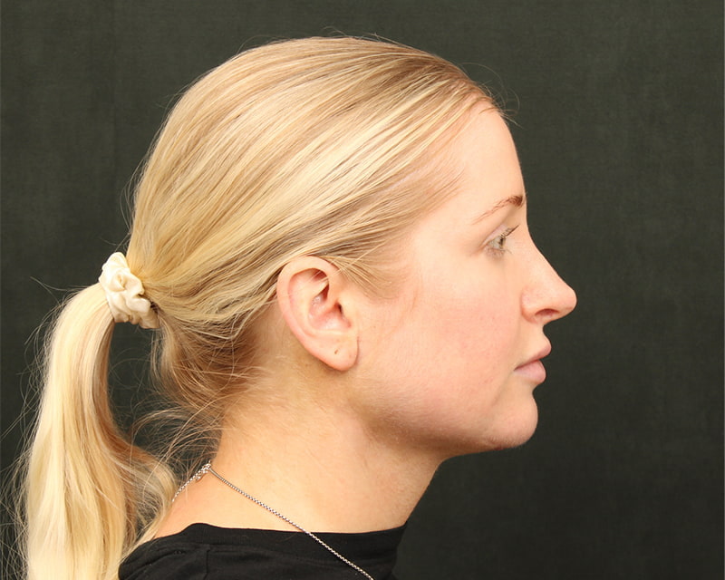 Midline Neck Lift Before & After Image